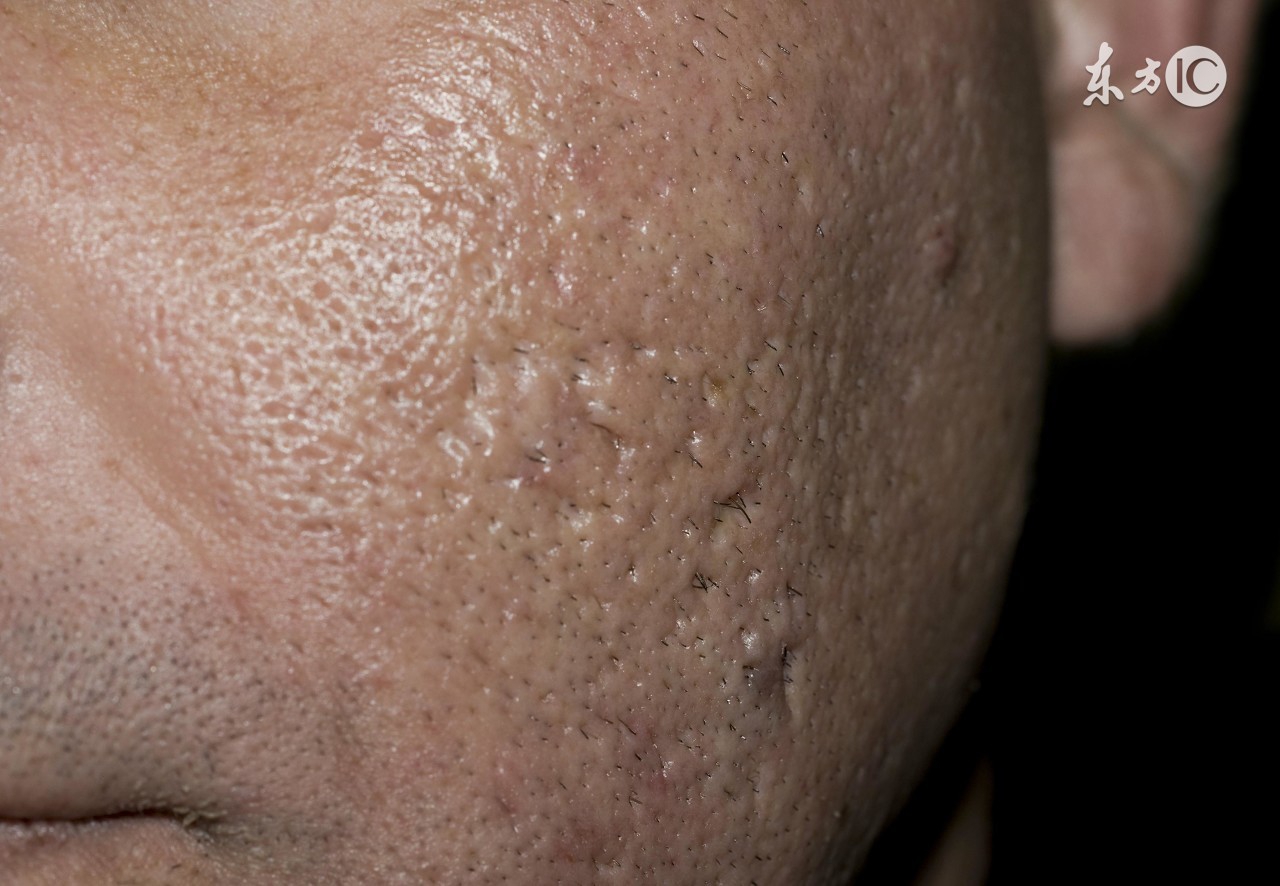 闭口粉刺最有效快速的方法,闭口粉刺最快最有效的办法