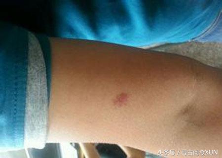 守宫砂的朱砂痣,朱砂痣跟守宫砂