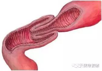 一岁宝宝受惊吓会导致肠套叠吗,肠套叠是晚上哭闹还是白天