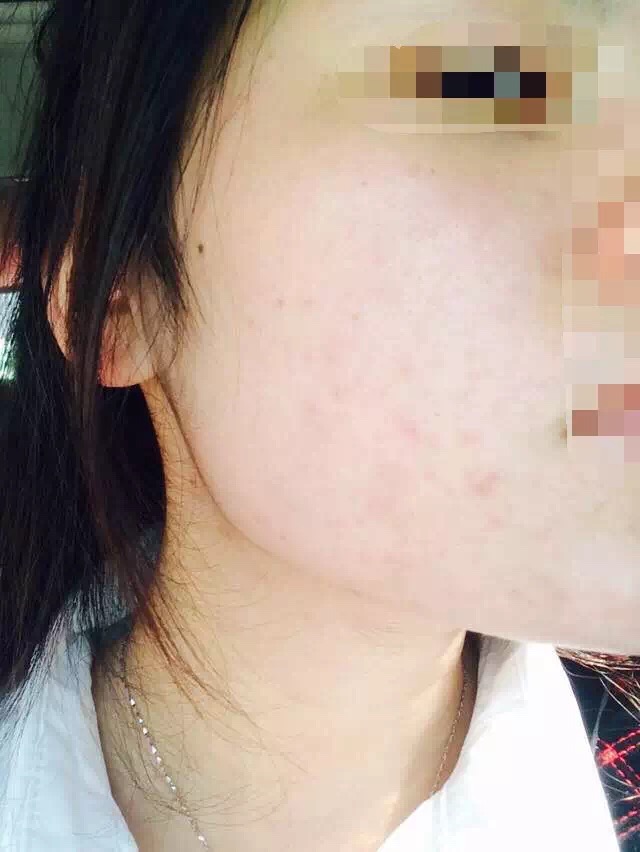 慎入！春季多发激素脸！你还要不要脸？