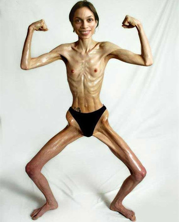 女孩过度减肥脚踝摔断了,女子减肥过度瘦成皮包骨头