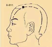 顽固性失眠，不妨试试针灸