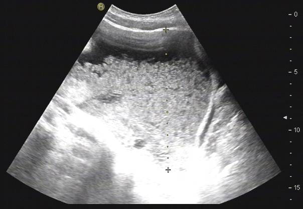 腹胀是怎么回事小心是这里生病了,腹胀是什么原因引起的胃不舒服