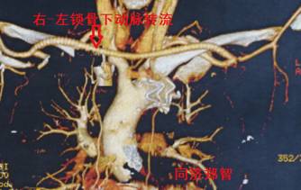 来了！建军节特别行动之探秘“主动脉夹层”