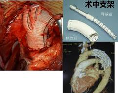来了！建军节特别行动之探秘“主动脉夹层”