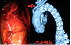 来了！建军节特别行动之探秘“主动脉夹层”