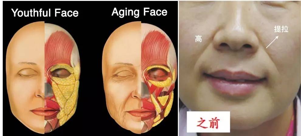 泪沟法令纹颈纹显老怎么办,改善泪沟法令纹全脸提升的方法