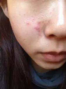 祛痘小窍门掌握了就不会有烦恼,最全祛痘攻略快速祛痘不留痕