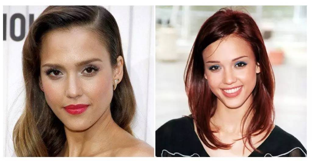 泪沟法令纹颈纹显老怎么办,改善泪沟法令纹全脸提升的方法