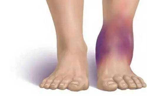 脚踝冷怎么保护,护脚踝防止脚踝过凉