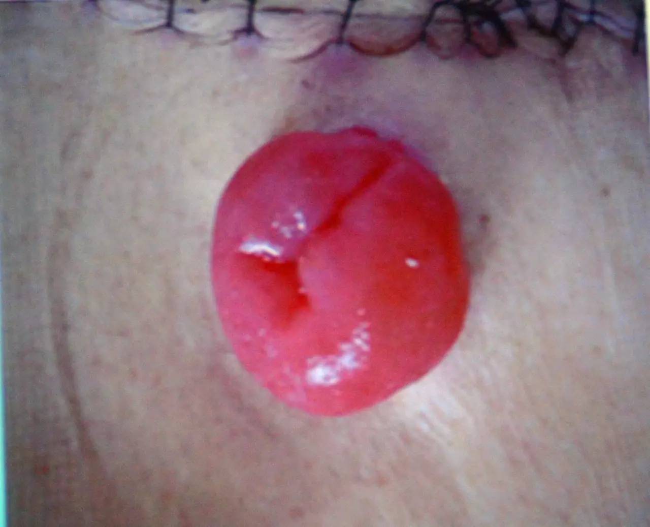 肠造口回纳的并发症是什么,膀胱全切肠造口有什么并发症