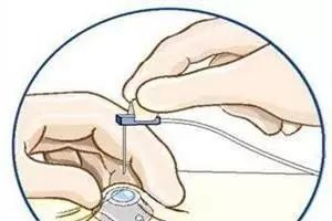 输液港蝶翼针的安置技巧,输液港蝶翼针使用方法视频
