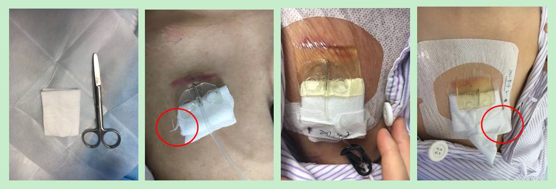 输液港蝶翼针的安置技巧,输液港蝶翼针使用方法视频