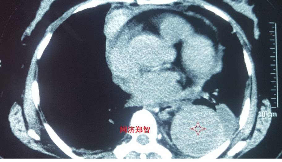 急性主动脉夹层cta影像诊断与鉴别,冠状动脉cta可以看到主动脉夹层吗