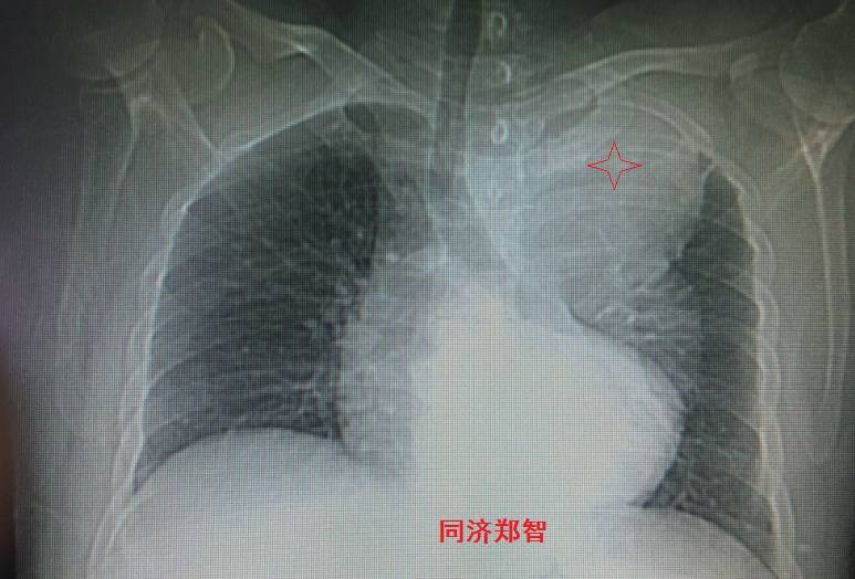 急性主动脉夹层cta影像诊断与鉴别,冠状动脉cta可以看到主动脉夹层吗