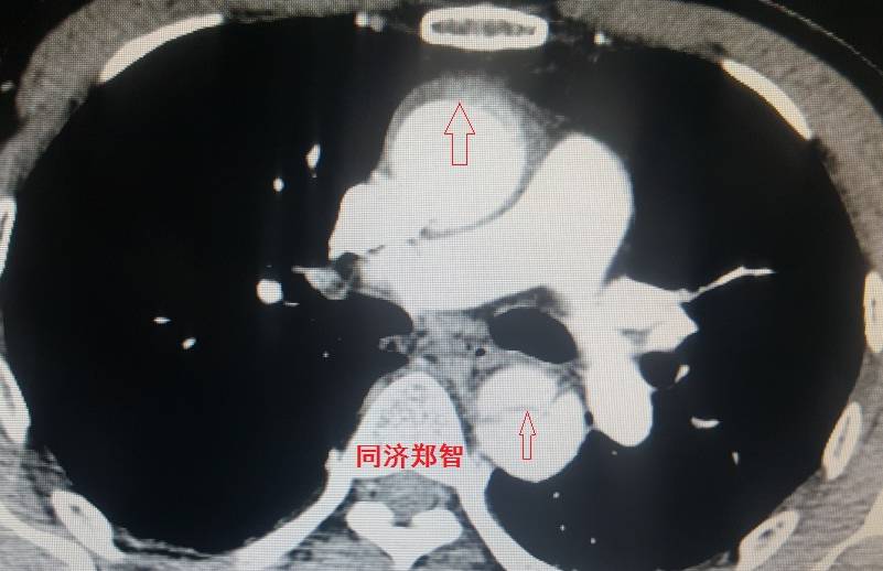急性主动脉夹层cta影像诊断与鉴别,冠状动脉cta可以看到主动脉夹层吗
