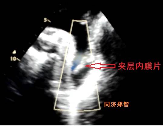 急性主动脉夹层cta影像诊断与鉴别,冠状动脉cta可以看到主动脉夹层吗