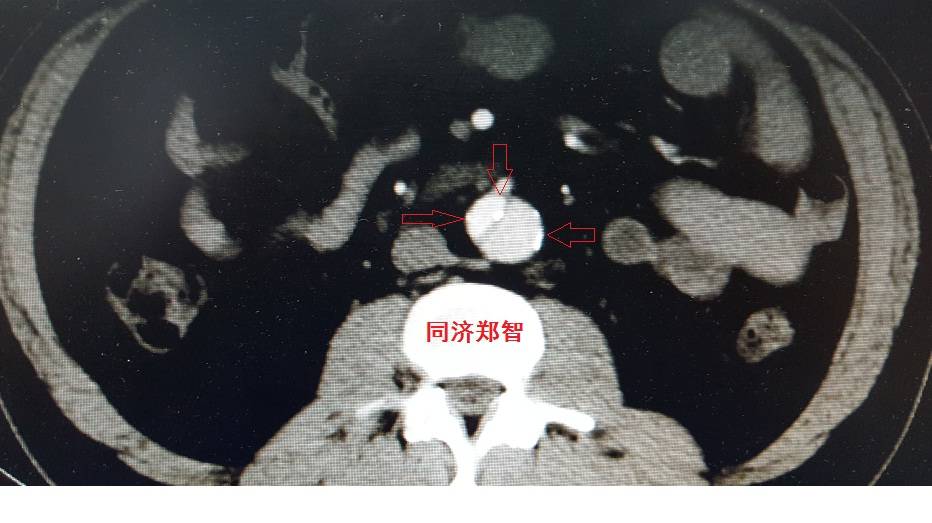 急性主动脉夹层cta影像诊断与鉴别,冠状动脉cta可以看到主动脉夹层吗