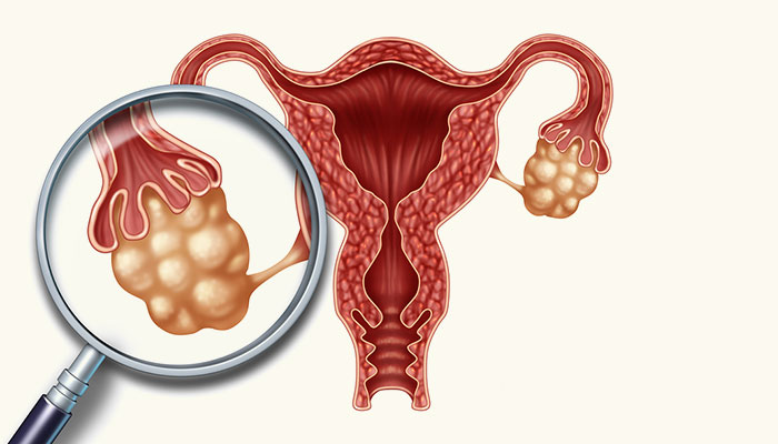 未生育女生小腹大是什么原因导致,贵州卵巢癌大肚子女子情况怎样