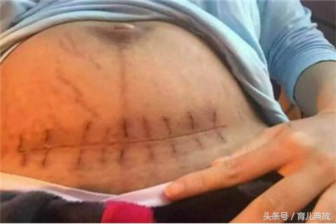 恢复得好的剖腹产疤痕,剖腹产后疤痕修复的四大误区