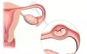 异位妊娠保守治疗护理诊断,异位妊娠保守治疗成功