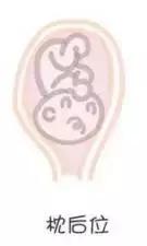 胎位不正如何纠正胎位,胎位不正纠正胎位最快方法