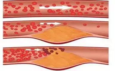 心梗直播间,心梗发病全过程视频