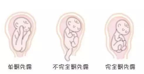 胎位不正如何纠正胎位,胎位不正纠正胎位最快方法
