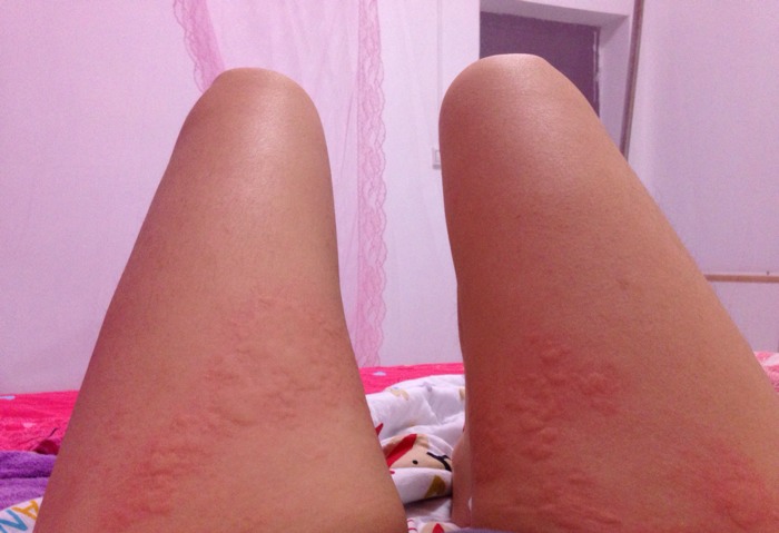 荨麻疹是怎么样兴起的,荨麻疹怎么治疗