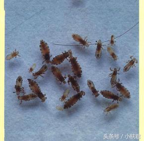 小孩头上长虱子是什么原因引起的,头发长虱子虫卵是什么原因引起的