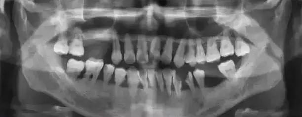 牙周炎简单易懂怎么解释,牙周炎犯了这三个方法轻松解决