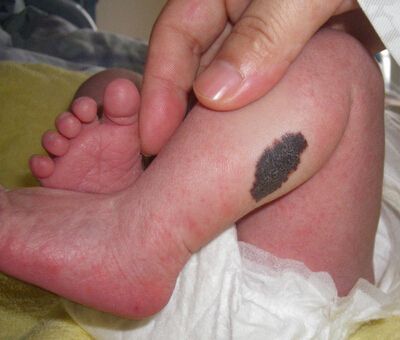 新生儿的各种胎记怎么避免,宝宝哪几种胎记很危险