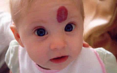 新生儿的各种胎记怎么避免,宝宝哪几种胎记很危险