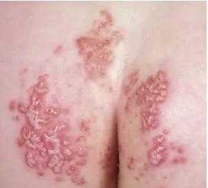 宝宝红屁股是不是老是哭,宝宝红屁股怎么缓解疼痛