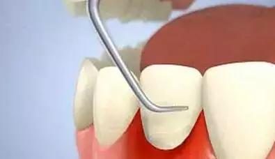 牙周炎简单易懂怎么解释,牙周炎犯了这三个方法轻松解决