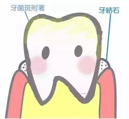 漫画｜牙结石是如何从一个“软妹”变成“硬汉”的？