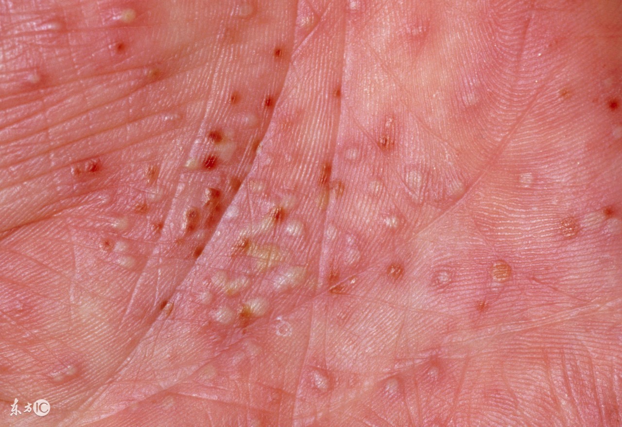 婴儿脸上湿疹结痂发黄怎么护理,婴儿湿疹你不知道的预防与护理