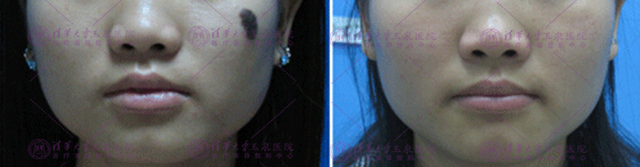 激光夏天做还是冬天做比较好,激光夏天做好还是冬天做好