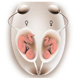 双子宫不怀孕是什么原因,双子宫不孕怎么办