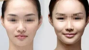 娱乐圈不老小妖精们的诀窍，玻尿酸的一二事儿~