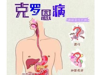 阐述什么是克罗恩病,克罗恩病通俗地讲是什么病