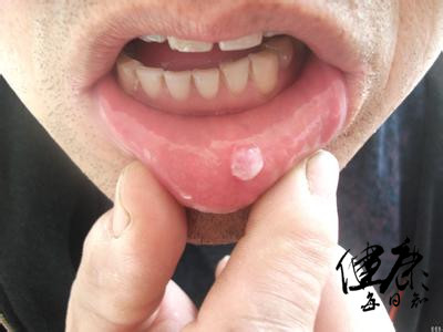 嘴巴上火起泡是病毒还是细菌,病毒性上火嘴上长泡多久能好