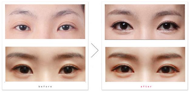 娱乐圈不老小妖精们的诀窍，玻尿酸的一二事儿~