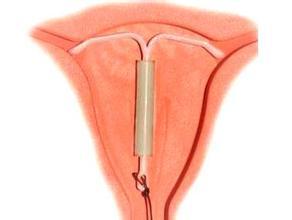 你还在考虑要不要上环吗