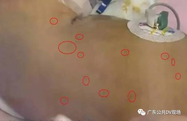 刚出生婴儿满身针孔,婴儿满身针孔性命垂危