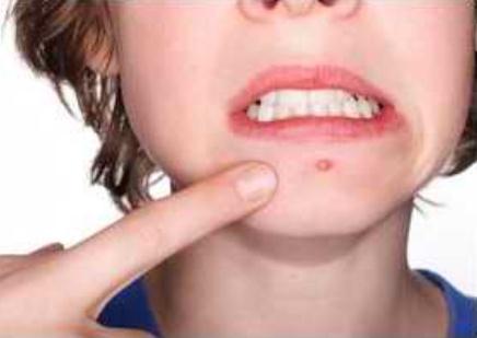 皮肤科医生推荐的淡化痘印方法,痘印顽固不化的原因