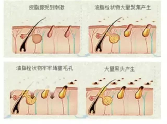 去黑头小妙招你的黑头有救了,别挤了教你去黑头的正确方法