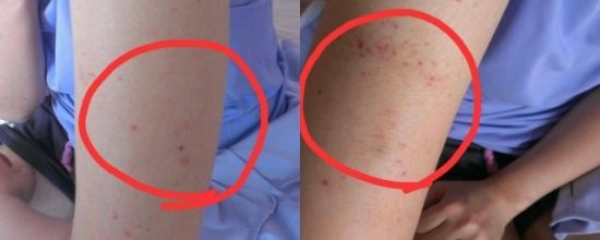 皮肤长小红痣不痛不痒是什么原因,身上长了好多小红痣是什么症状