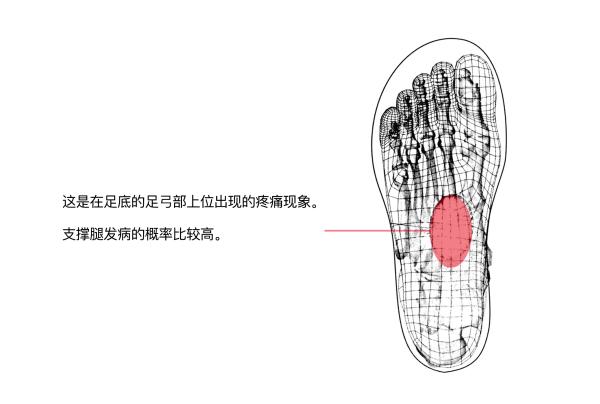 足底筋膜炎康复训练,如何改善脚底筋膜炎