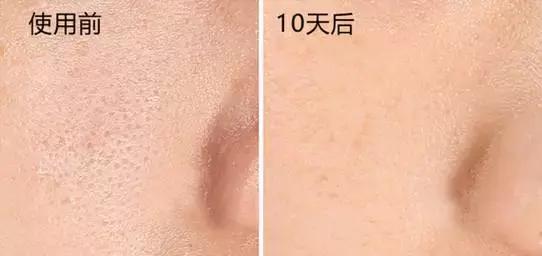 去黑头小妙招你的黑头有救了,别挤了教你去黑头的正确方法